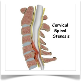 Spinal Decompression Toronto - Stenosis